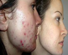 Load image into Gallery viewer, Acne Peel