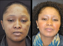 Load image into Gallery viewer, Acne Peel