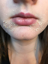 Load image into Gallery viewer, Acne Peel