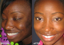 Load image into Gallery viewer, Acne Peel