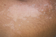 Load image into Gallery viewer, Acne Peel