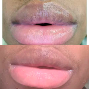 Hyperpigmentation Lip Corrector