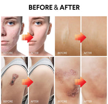 Load image into Gallery viewer, Magic Stretch Mark Remover
